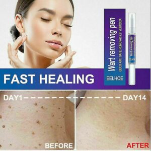 Warts Remover Original Cream Wart Removal Ointment Wart Treatment Skin Tag Mole Remover Antibacterial Foot Wart